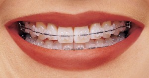 42vyravnivaniya-zubov