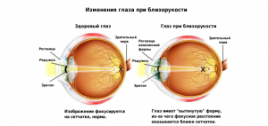 Глазные спазмы