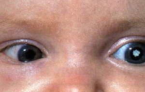 Как лечится врожденная катаракта у ребенка?