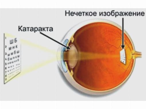 Причины катаракты </ />» title=»Причины катаракты </br>» /><figcaption>Причины катаракты </br></figcaption></span></figure>
<figure tabindex=