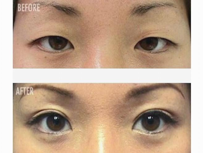 Фото до и после при коррекции азиатского разреза глаз