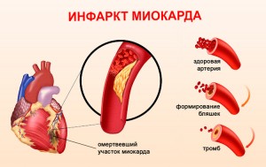 infarkt-miokarda_4-4