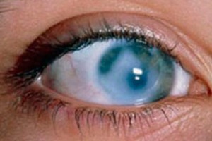 Бельмо или лейкома на глазу