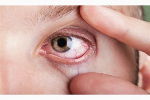 Жжение в глазах — причины и лечение