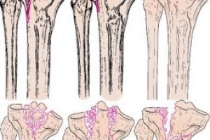 Перелом большеберцовой кости
