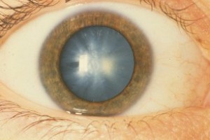 Виды катаракты, методы лечения и профилактика