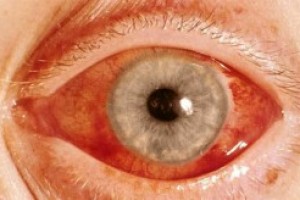 Первичная открытоугольная глаукома