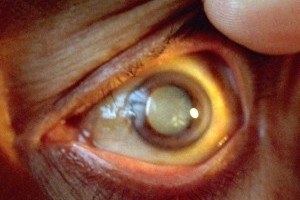 Катаракта очень распространенное заболевание глаз