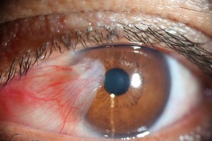 Раковые заболевания глаза: виды
