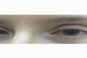Лазерное укрепление сетчатки глаза