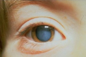 Катаракта – заболевание глаз