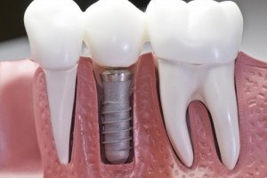 Что такое имплантация зубов – вкратце