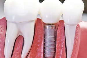 Протезирование зубов — прогрессивный метод восстановления костной ткани