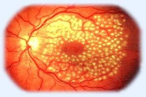 Стволовые клетки вернут зрение!