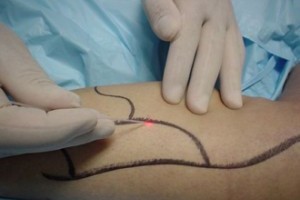 Лечение варикозного расширения вен посредством лазера
