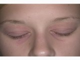 Аллергия на веках – глаз, причины, симптомы