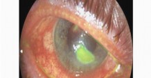 Повреждение роговицы глаза. Лечение