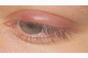 Лечение халязиона на глазу