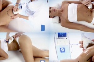Неоперативное лечение миомы матки