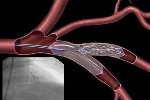 Стентирование коронарных артерий – метод лечения ишемической болезни сердца