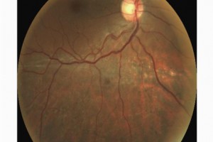 Дистрофия роговицы глаза — причины