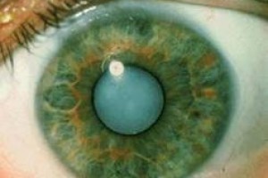 Симптомы и лечение катаракты