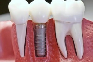 Имплантации зубов