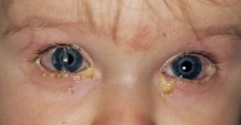 Гноятся глаза у ребенка — в чем причина?