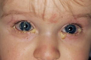 Гноятся глаза у ребенка — в чем причина?