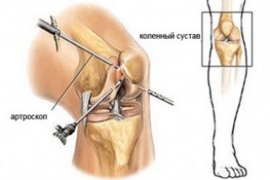 Артроскопия коленного сустава в Израиле при разрыве мениска