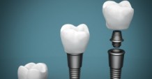 Варианты экспресс-имплантации зубов