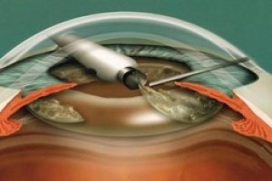 Лечение катаракты посредством ультразвуковой факоэмульсификации