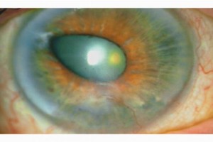 Язва роговицы глаза у человека: лечение