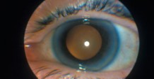 Приобретенная и врожденная катаракта