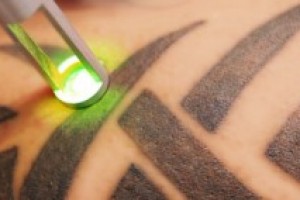 Инновационный лазер удалит любую татуировку без следа!