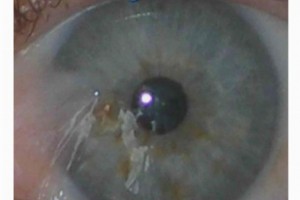 Список болезней роговицы глаза