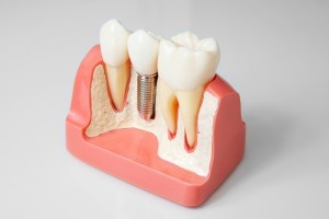 Протезирование в стоматологии: современное восстановление зубного ряда