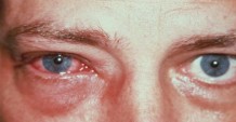 Воспаление глаз
