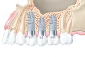 Зубные имплантанты XiVE