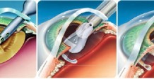 Симптомы и лечение приобретенной катаракты